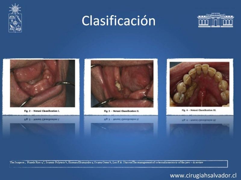 Diapositiva 12 de Osteoradionecrosis