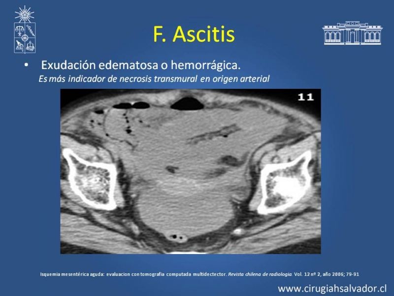 Diapositiva 23 de Isquemia Mesentérica