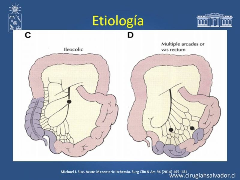Diapositiva 7 de Isquemia Mesentérica