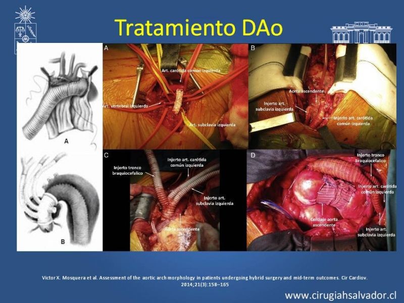 Diapositiva 32 de Sindrome Aórtico Agudo (SAA)