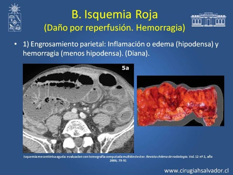Diapositiva 16 de Isquemia Mesentérica