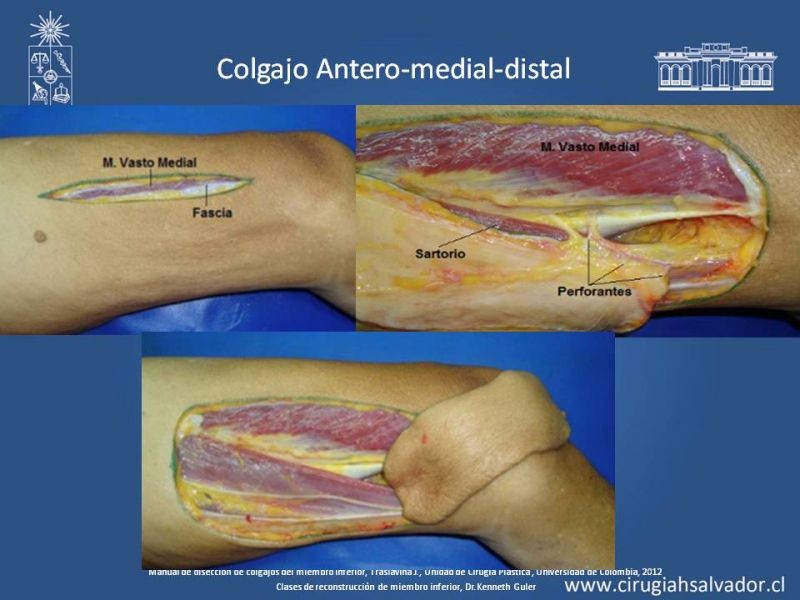 Diapositiva 26 de Cobertura de miembro inferior