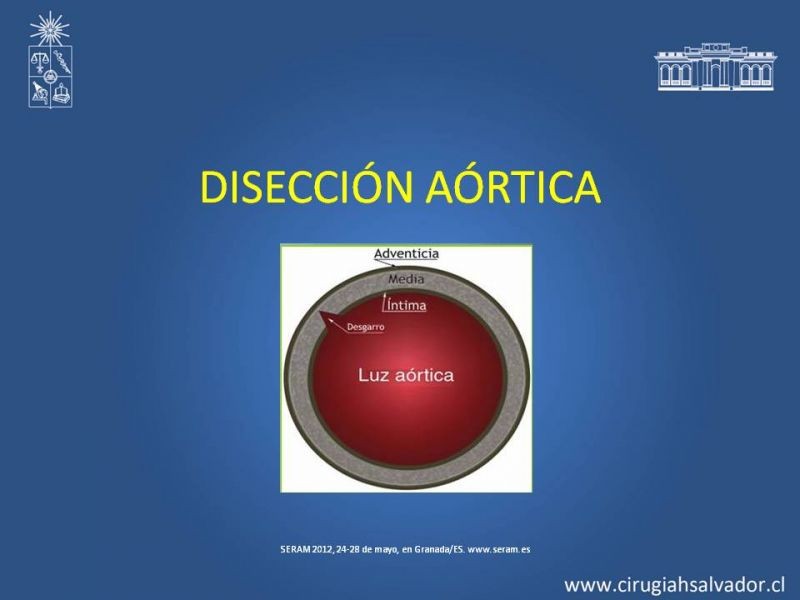 Diapositiva 7 de Sindrome Aórtico Agudo (SAA)