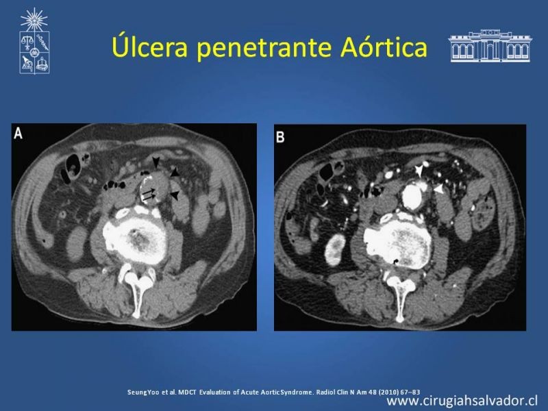Diapositiva 28 de Sindrome Aórtico Agudo (SAA)