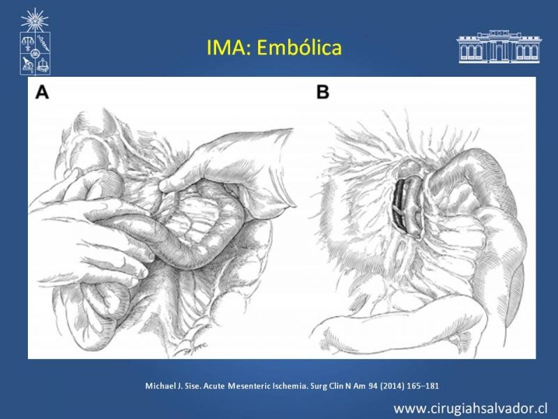 Diapositiva 28 de Isquemia Mesentérica
