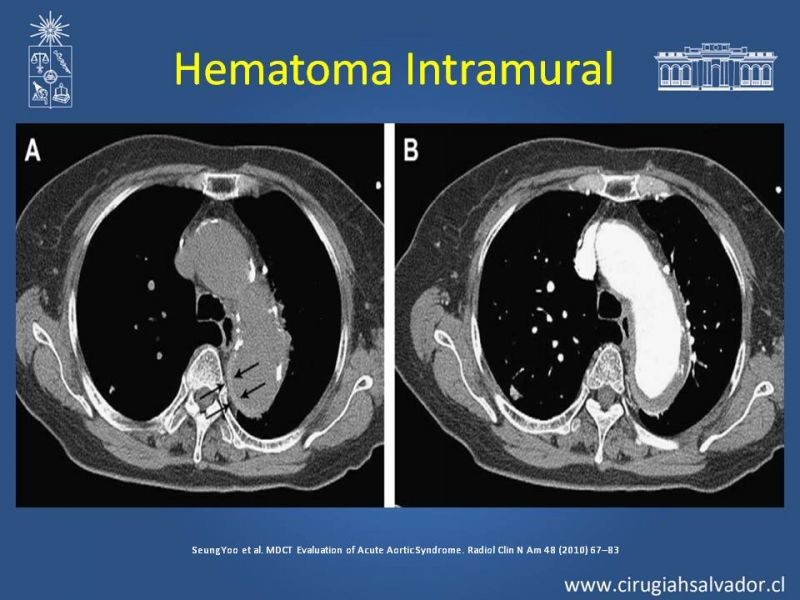 Diapositiva 21 de Sindrome Aórtico Agudo (SAA)