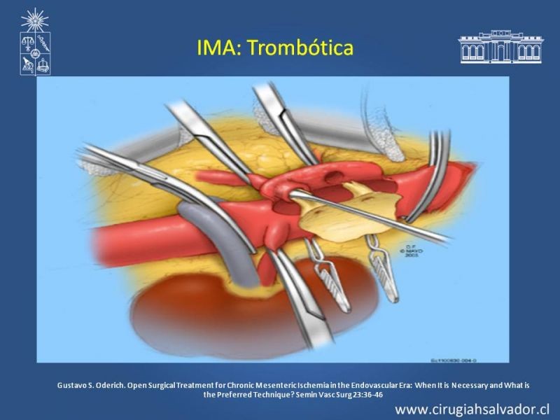 Diapositiva 33 de Isquemia Mesentérica