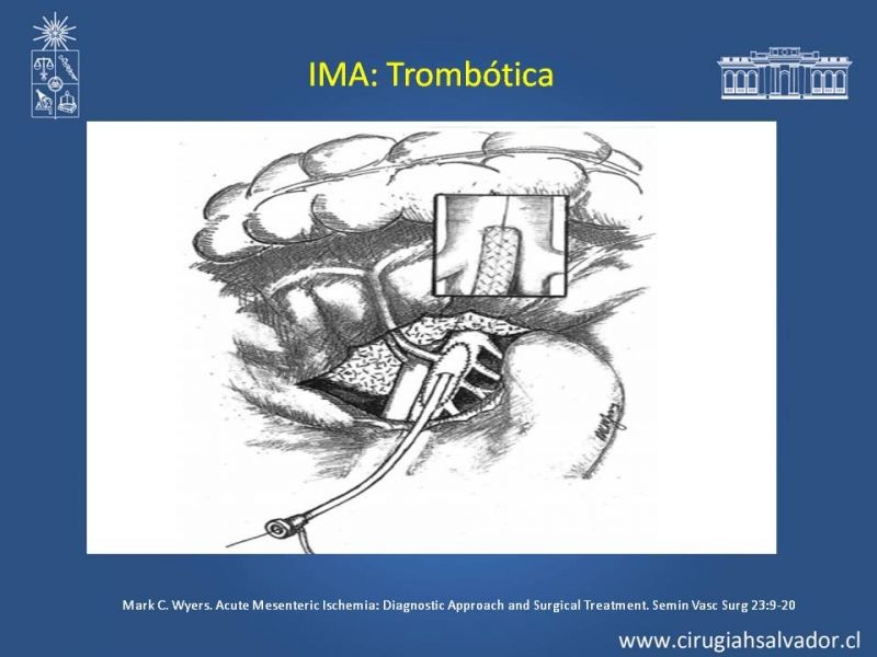 Diapositiva 36 de Isquemia Mesentérica