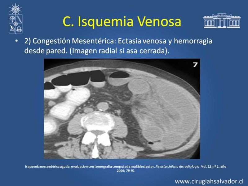 Diapositiva 19 de Isquemia Mesentérica