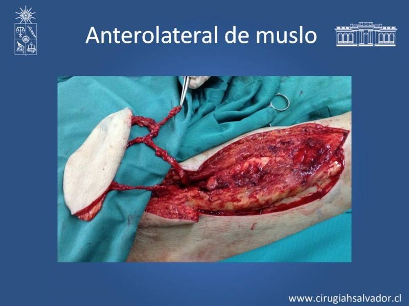 Diapositiva 20 de Usos de Colgajos Perforantes