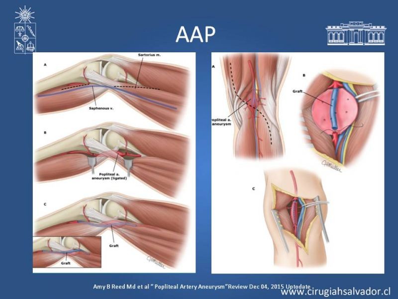 Diapositiva 15 de Aneurismas Perisféricos