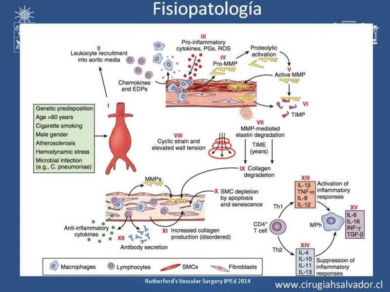 Diapositiva 5 de Aneurismas Perisféricos