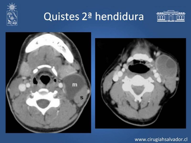 Diapositiva 15 de Quistes Branquiales