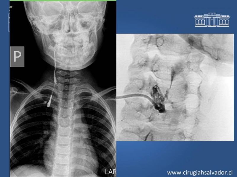 Diapositiva 14 de Quistes Branquiales