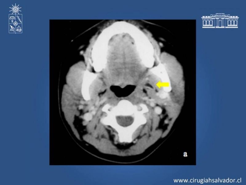 Diapositiva 16 de Quistes Branquiales