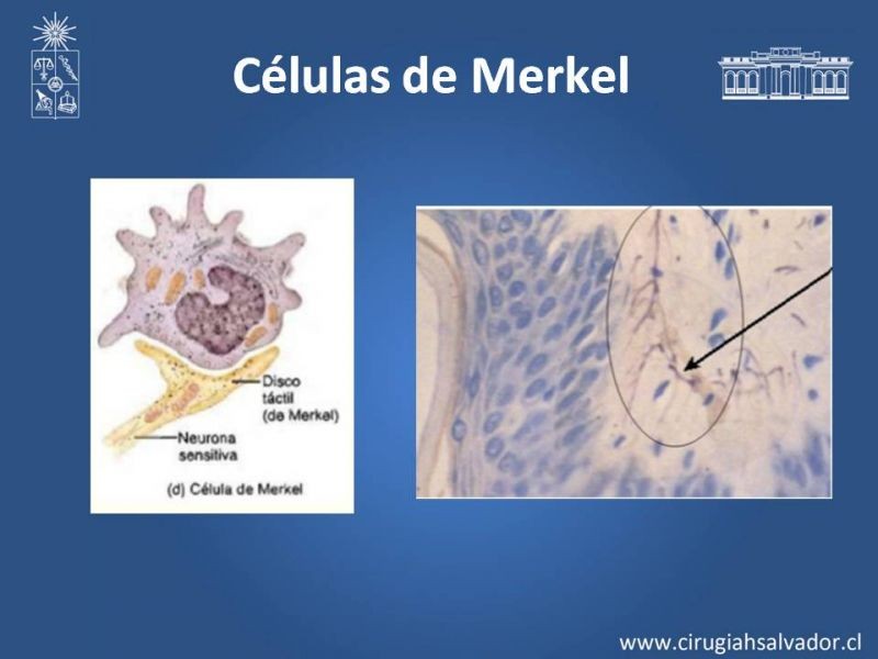 Diapositiva 2 de Tumores de células de Merkel
