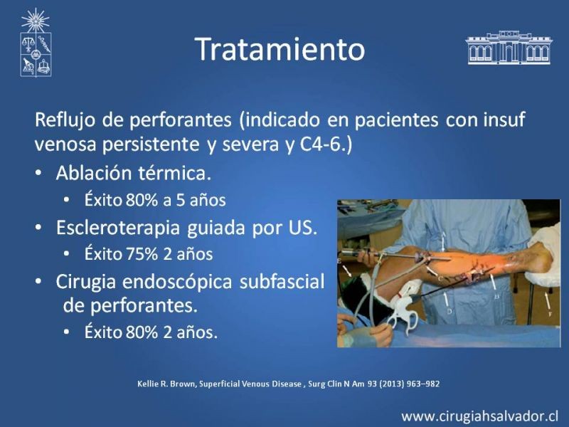 Diapositiva 21 de Insuficiencia venosa superficial