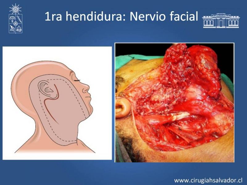 Diapositiva 20 de Quistes Branquiales