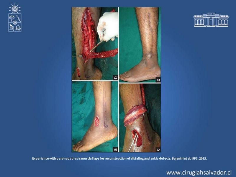 Diapositiva 22 de Usos de Colgajos Perforantes