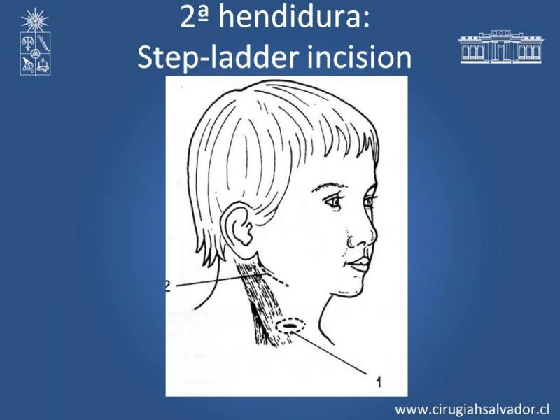 Diapositiva 21 de Quistes Branquiales