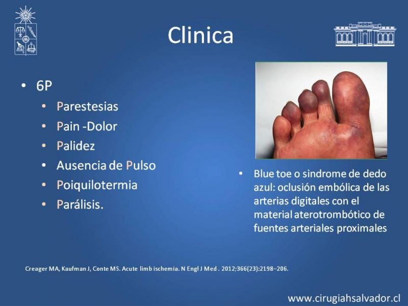 Diapositiva 8 de Isquemia aguda extremidades