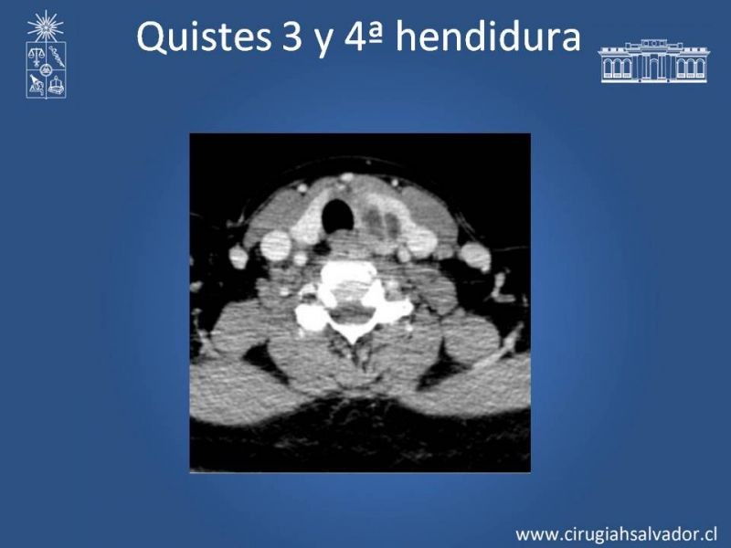 Diapositiva 18 de Quistes Branquiales