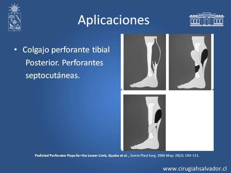 Diapositiva 21 de Usos de Colgajos Perforantes