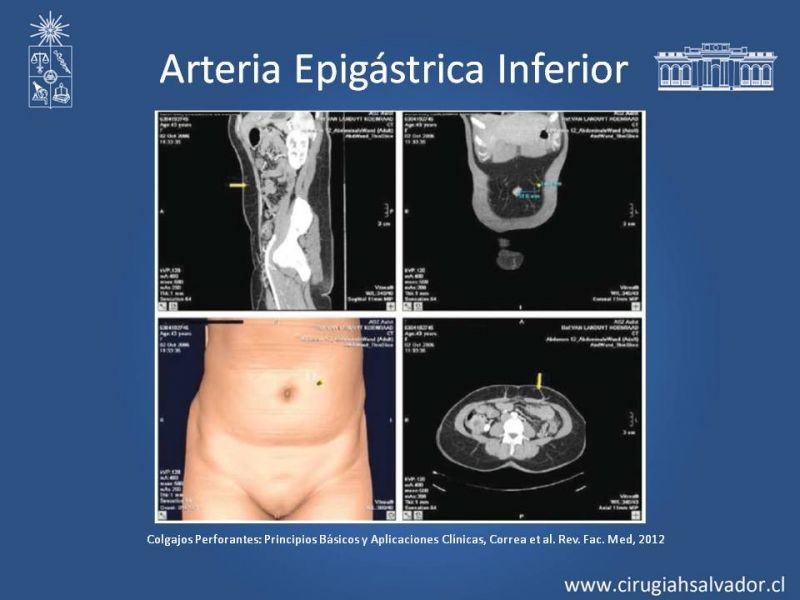 Diapositiva 17 de Usos de Colgajos Perforantes
