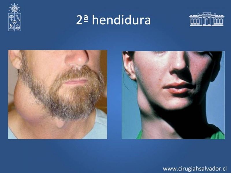 Diapositiva 10 de Quistes Branquiales