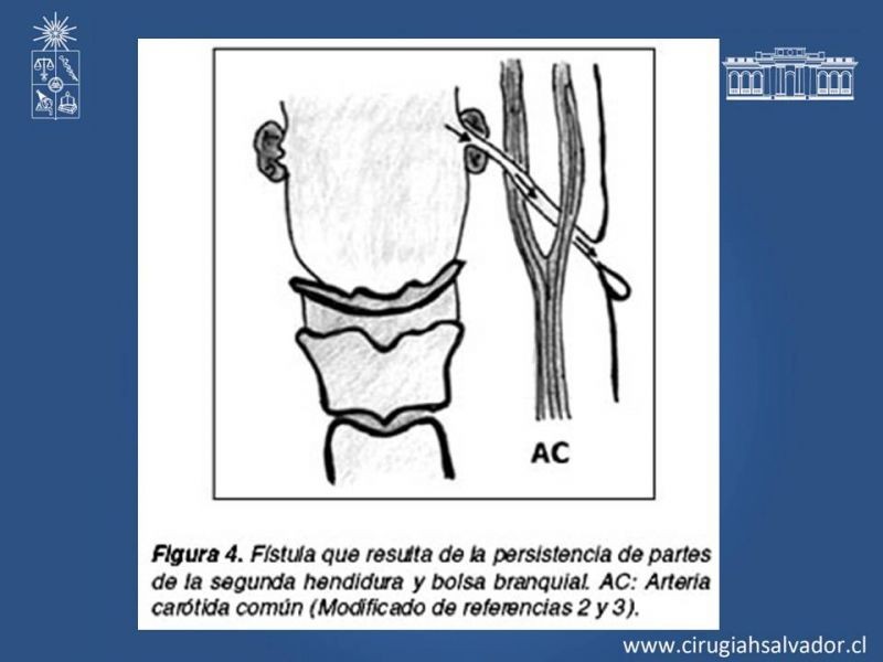 Diapositiva 6 de Quistes Branquiales