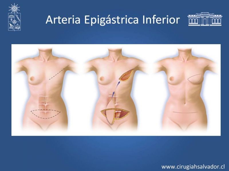 Diapositiva 18 de Usos de Colgajos Perforantes