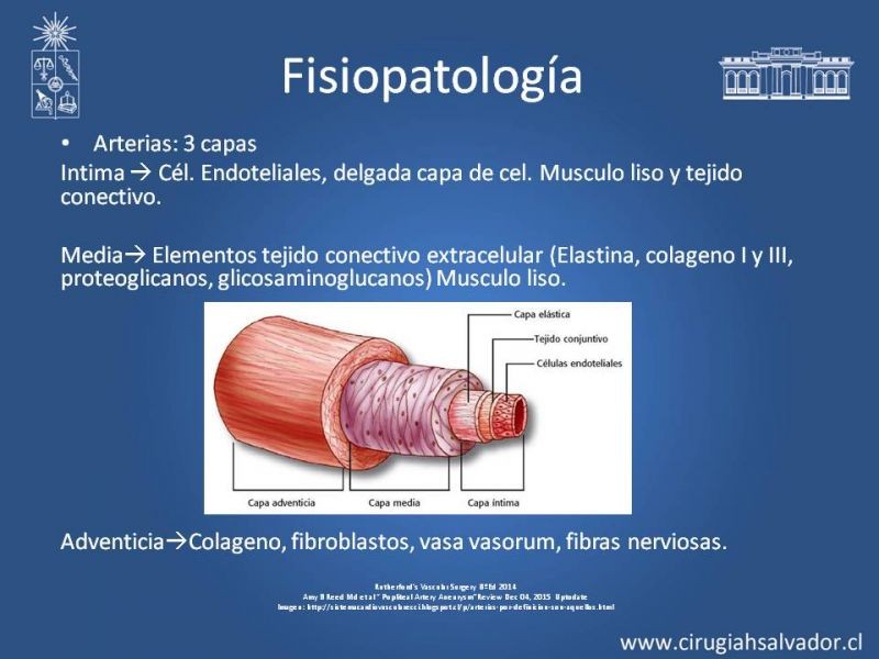Diapositiva 4 de Aneurismas Perisféricos