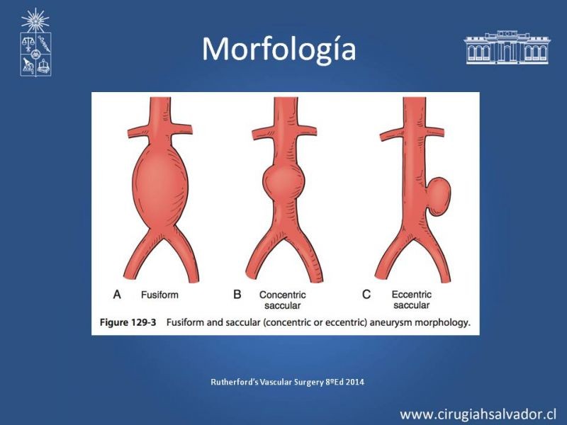 Diapositiva 6 de Aneurismas Perisféricos