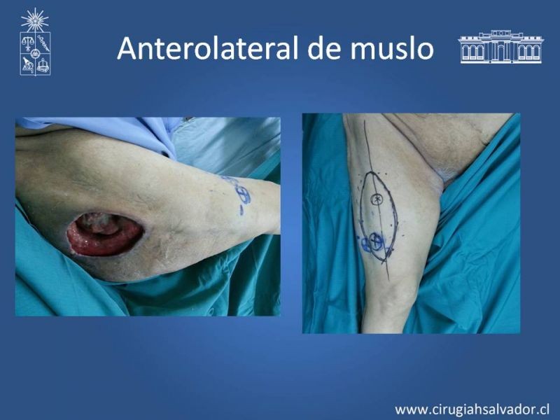 Diapositiva 19 de Usos de Colgajos Perforantes