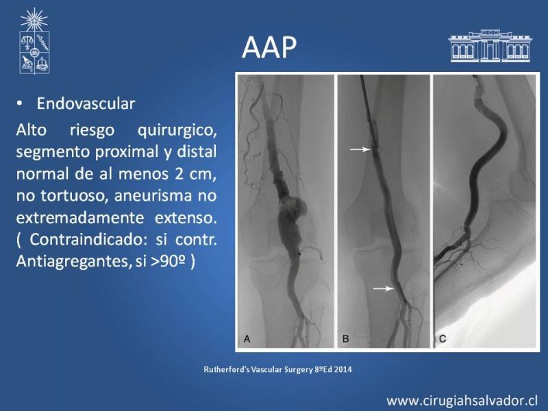 Diapositiva 14 de Aneurismas Perisféricos