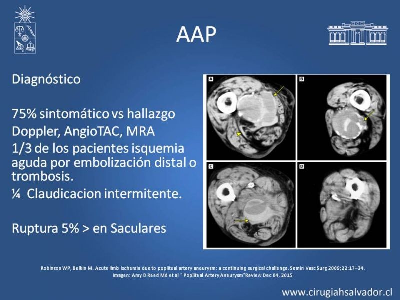 Diapositiva 11 de Aneurismas Perisféricos