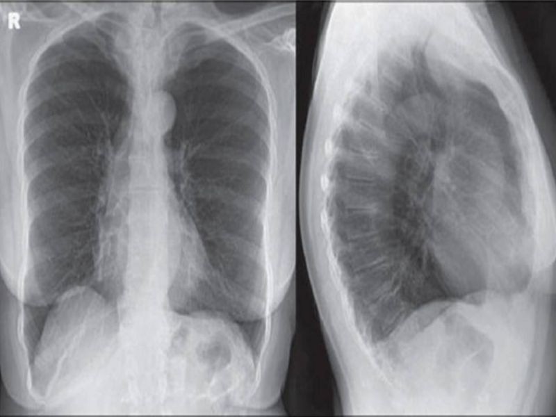 Diapositiva 9 de Bocio intratorácico