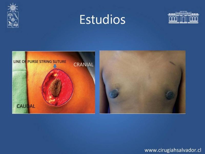 Diapositiva 17 de Ginecomastia