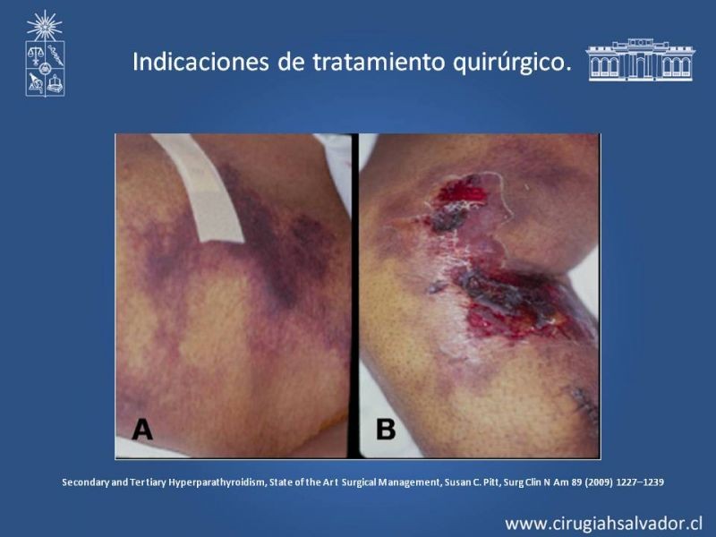 Diapositiva 18 de Hiperparatiroidismo 2º: Estudio, manejo e indicaciones quirúrgicas.