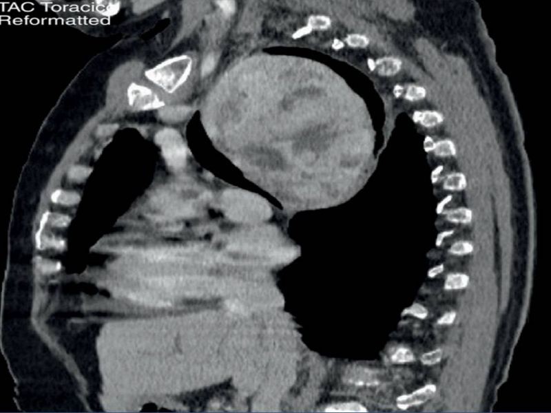 Diapositiva 11 de Bocio intratorácico