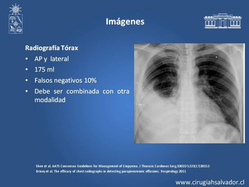 Diapositiva 6 de Empiema