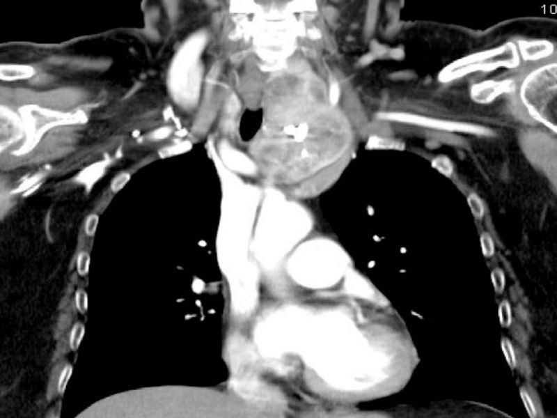 Diapositiva 10 de Bocio intratorácico