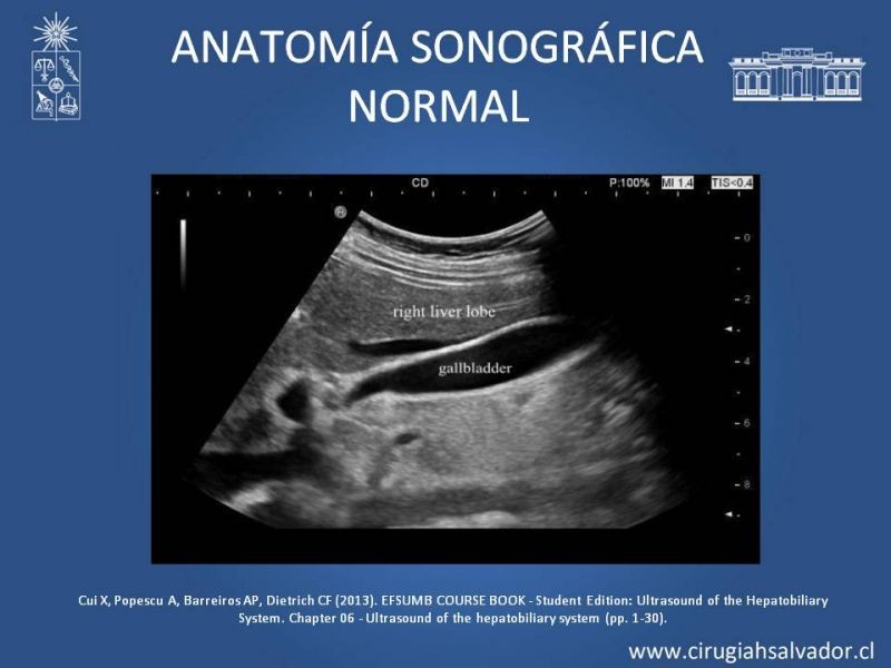 Diapositiva 6 de Vesícula Escleroatrófica