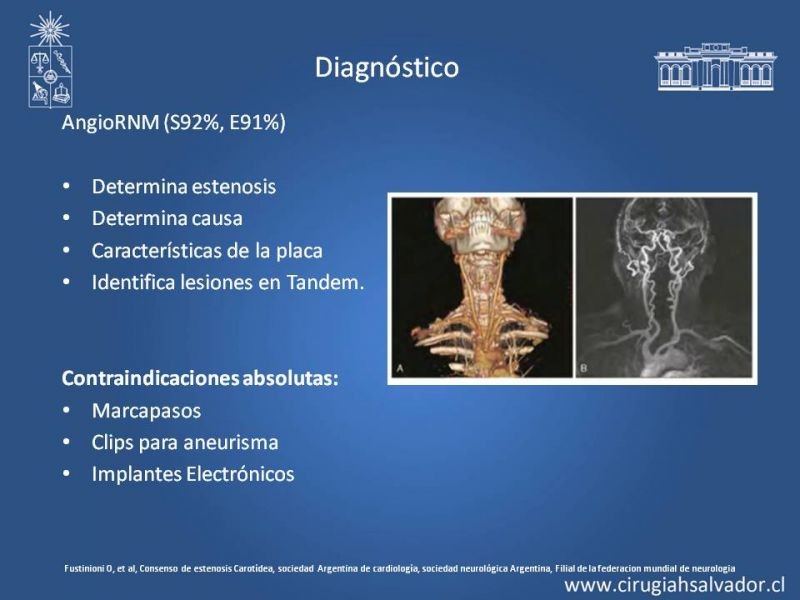 Diapositiva 14 de Estenosis Carotidea: Estudio y manejo quirúrgico