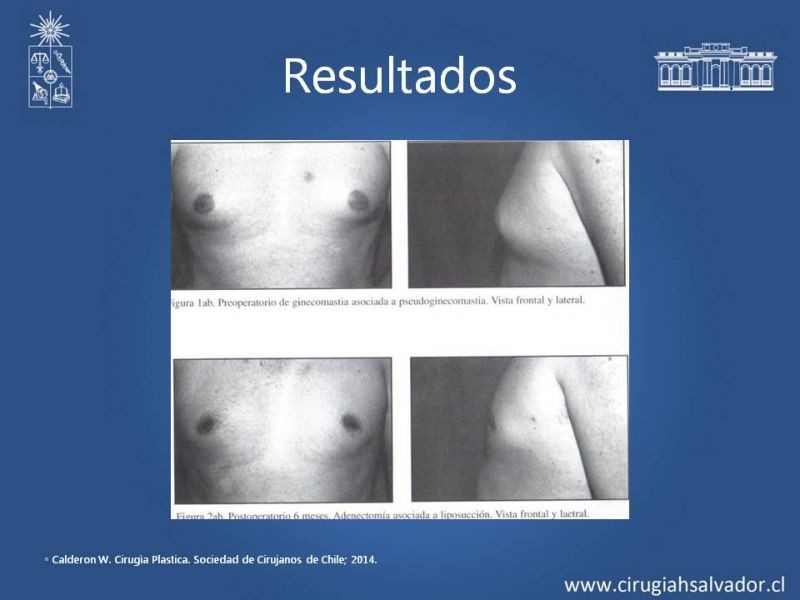 Diapositiva 13 de Ginecomastia