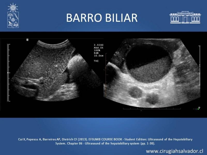 Diapositiva 14 de Vesícula Escleroatrófica