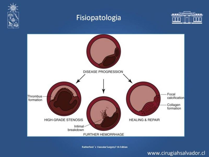 Diapositiva 5 de Estenosis Carotidea: Estudio y manejo quirúrgico