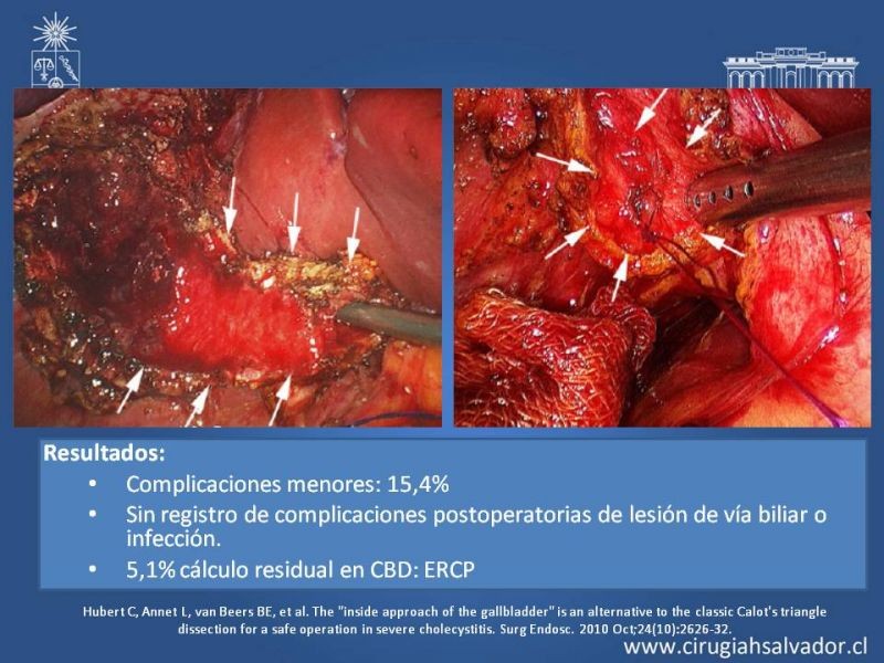 Diapositiva 61 de Vesícula Escleroatrófica