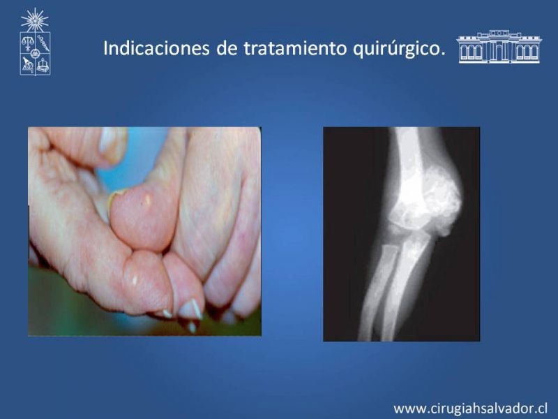 Diapositiva 17 de Hiperparatiroidismo 2º: Estudio, manejo e indicaciones quirúrgicas.