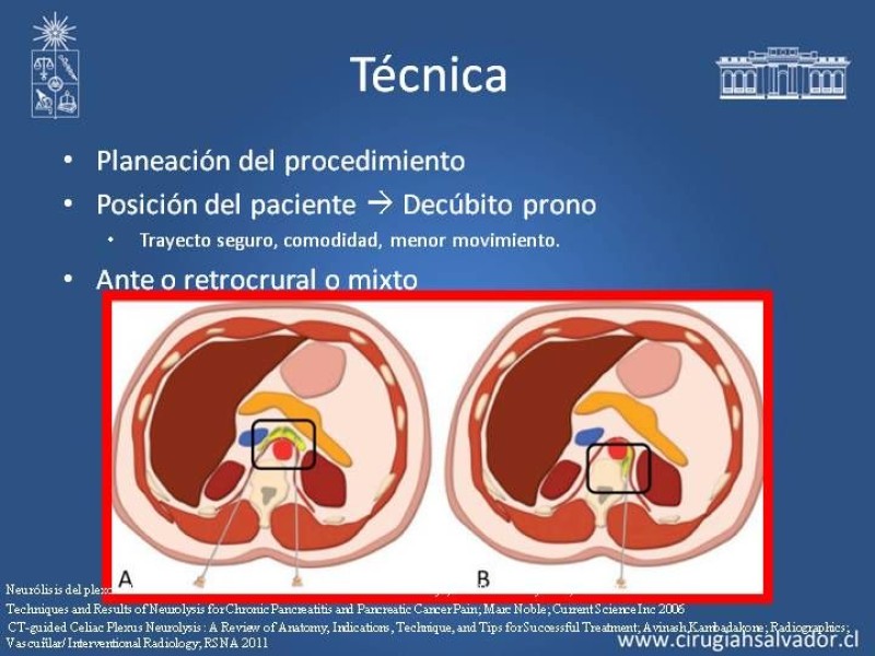 Diapositiva 9 de Alcoholización Plexo Solar